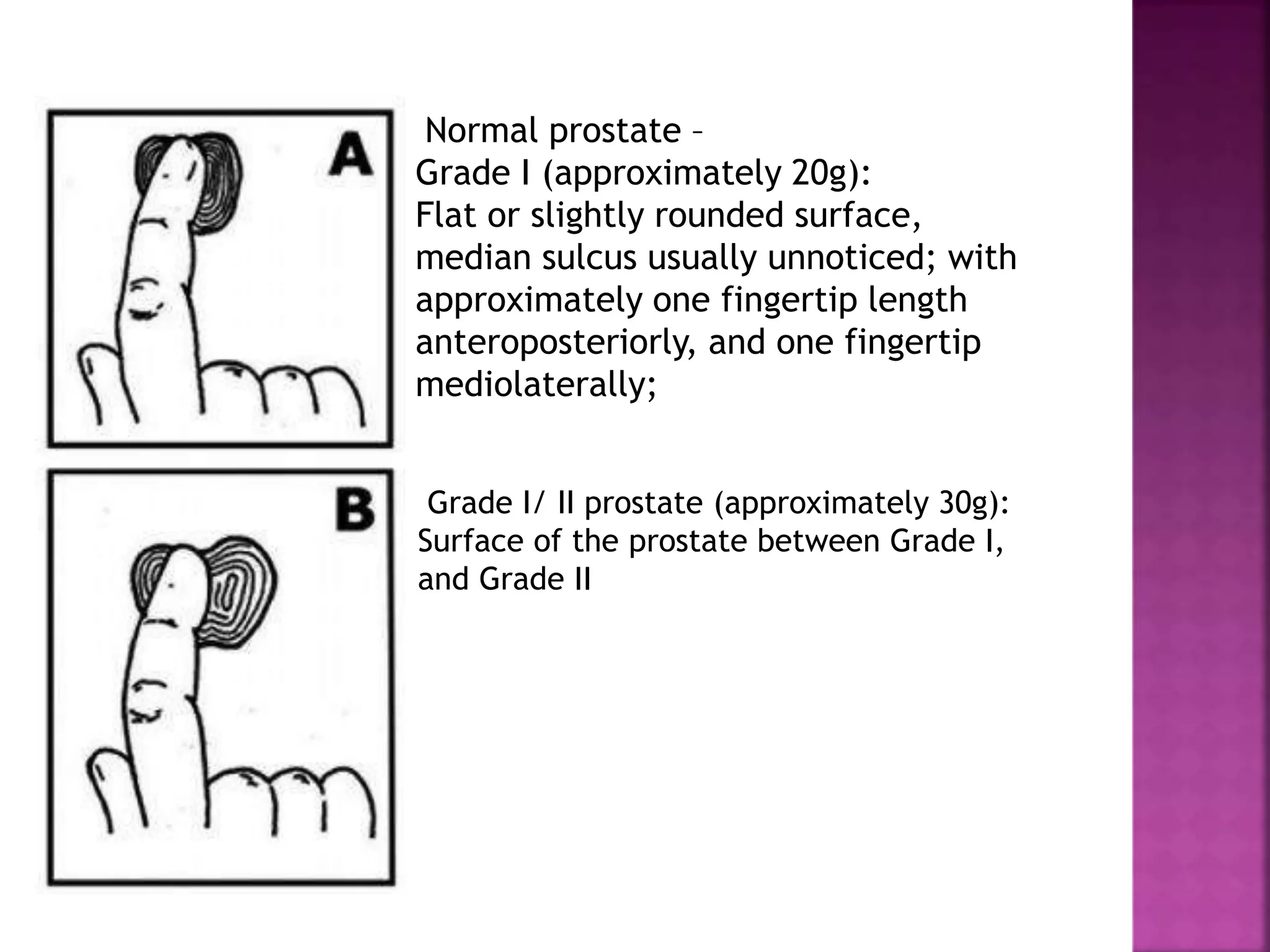 Normal prostate –
Grade I (approximately 20g):
Flat or slightly rounded surface,
median sulcus usually unnoticed; with
approximately one fingertip length
anteroposteriorly, and one fingertip
mediolaterally;
Grade I/ II prostate (approximately 30g):
Surface of the prostate between Grade I,
and Grade II
 
