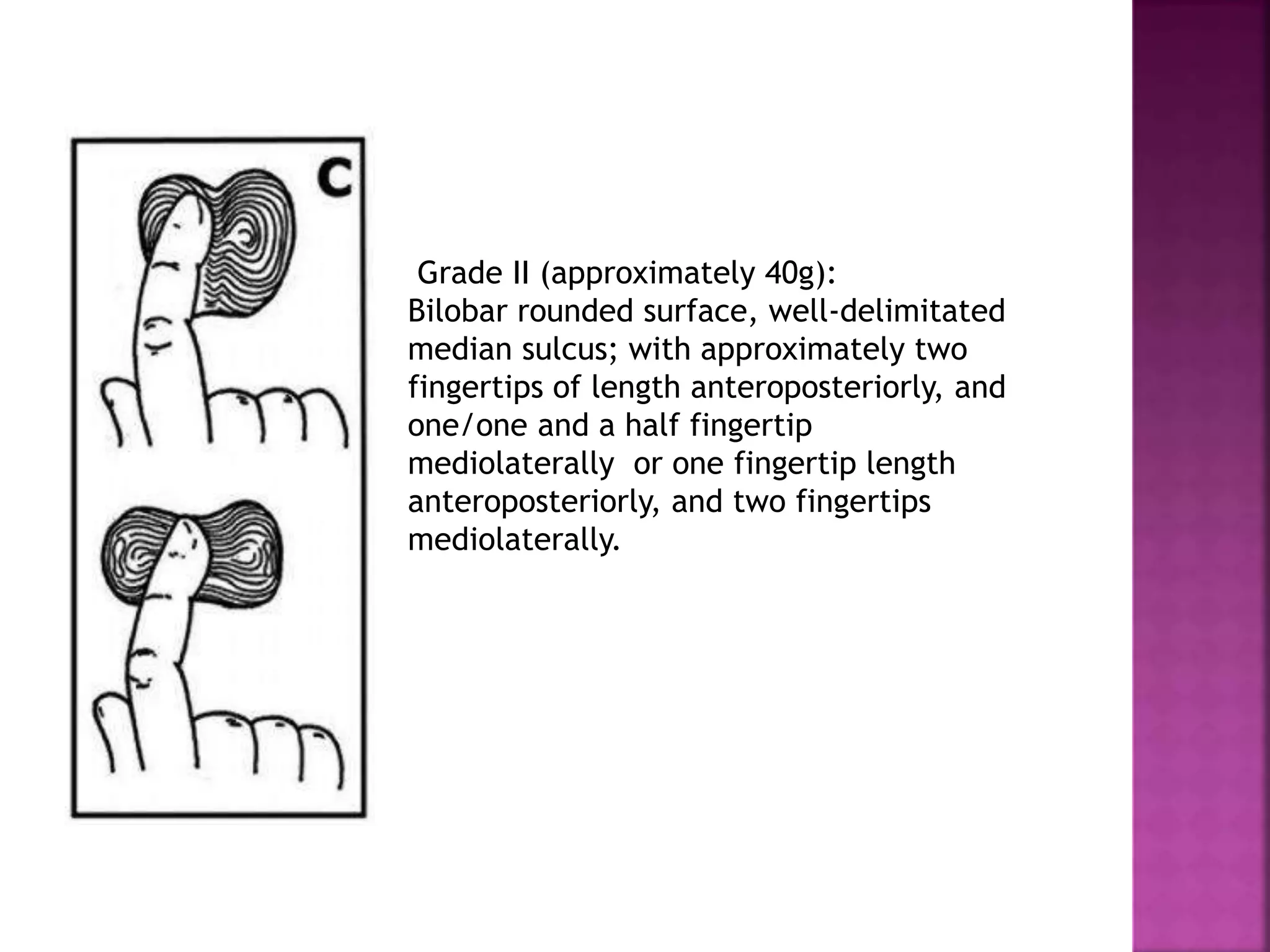 Grade II (approximately 40g):
Bilobar rounded surface, well-delimitated
median sulcus; with approximately two
fingertips of length anteroposteriorly, and
one/one and a half fingertip
mediolaterally or one fingertip length
anteroposteriorly, and two fingertips
mediolaterally.
 