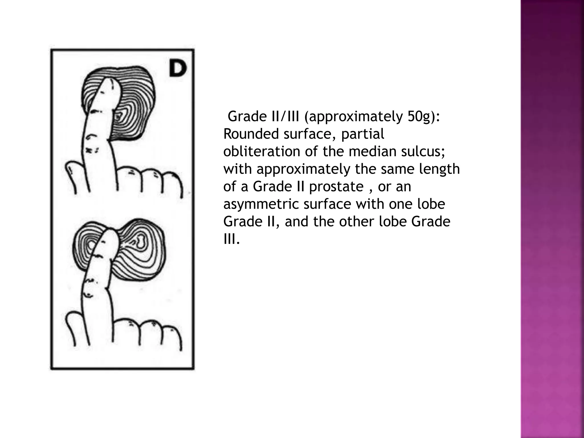 Grade II/III (approximately 50g):
Rounded surface, partial
obliteration of the median sulcus;
with approximately the same length
of a Grade II prostate , or an
asymmetric surface with one lobe
Grade II, and the other lobe Grade
III.
 