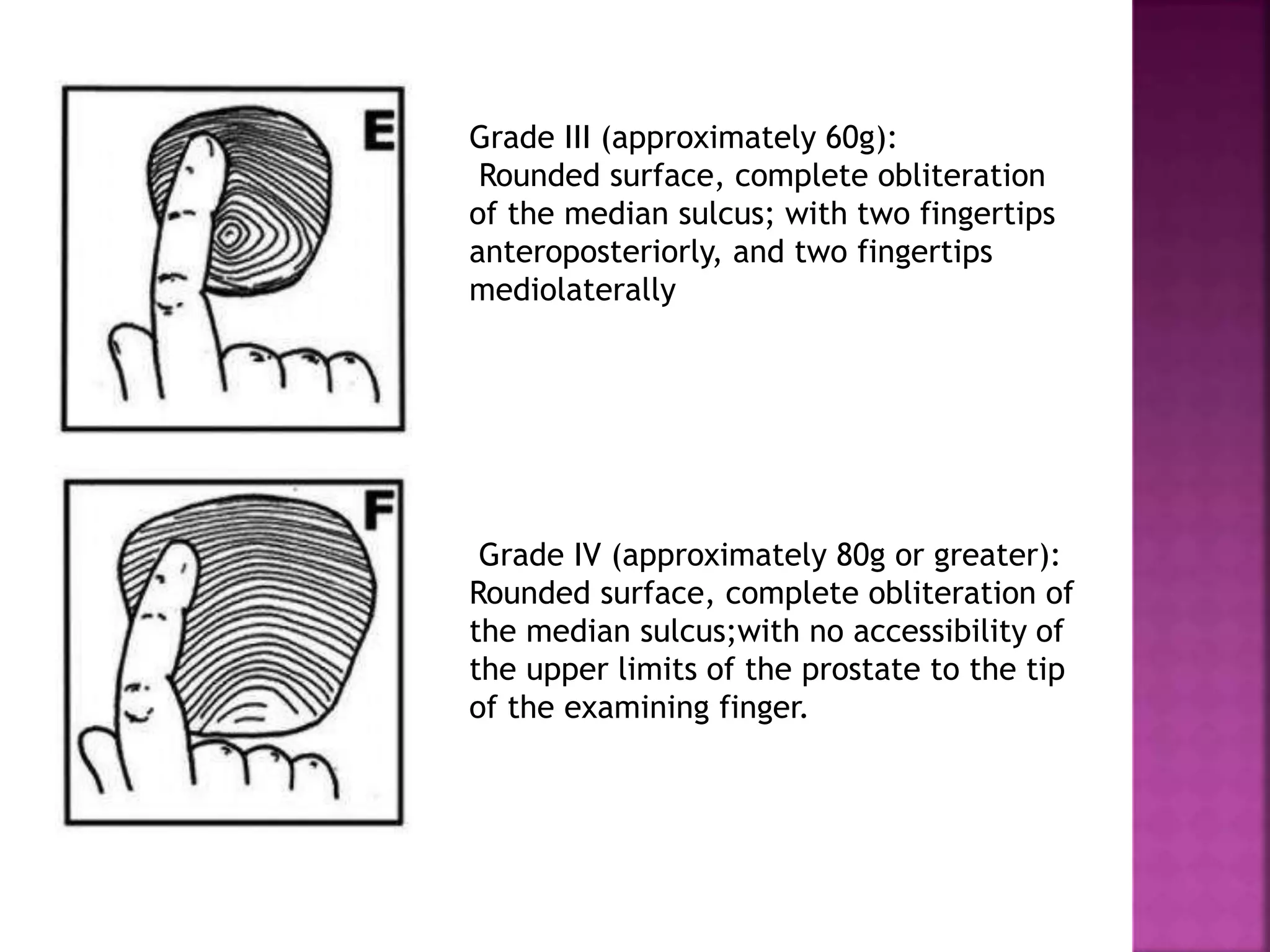 Grade III (approximately 60g):
Rounded surface, complete obliteration
of the median sulcus; with two fingertips
anteroposteriorly, and two fingertips
mediolaterally
Grade IV (approximately 80g or greater):
Rounded surface, complete obliteration of
the median sulcus;with no accessibility of
the upper limits of the prostate to the tip
of the examining finger.
 