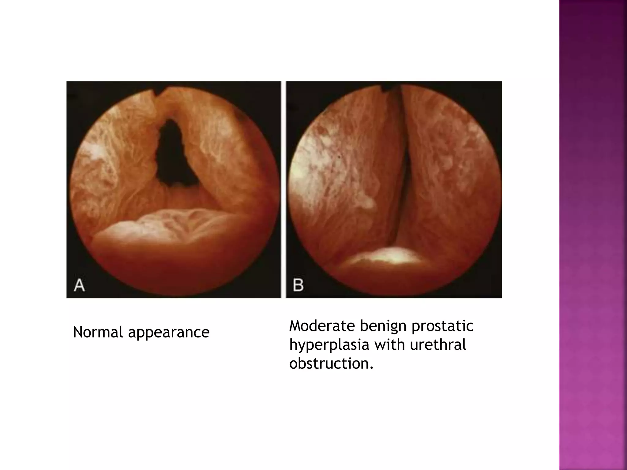 Normal appearance Moderate benign prostatic
hyperplasia with urethral
obstruction.
 
