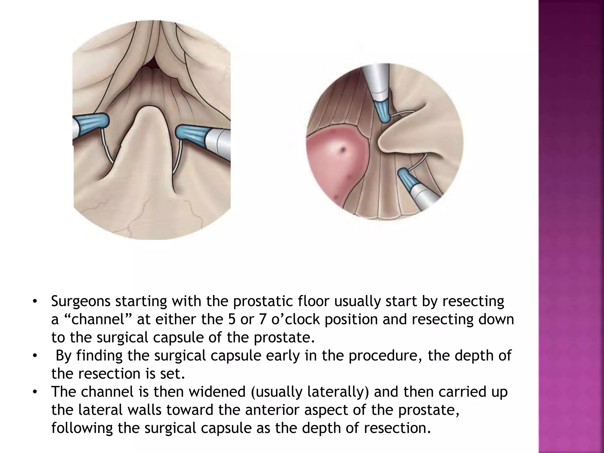 • Surgeons starting with the prostatic floor usually start by resecting
a “channel” at either the 5 or 7 o’clock position and resecting down
to the surgical capsule of the prostate.
• By finding the surgical capsule early in the procedure, the depth of
the resection is set.
• The channel is then widened (usually laterally) and then carried up
the lateral walls toward the anterior aspect of the prostate,
following the surgical capsule as the depth of resection.
 