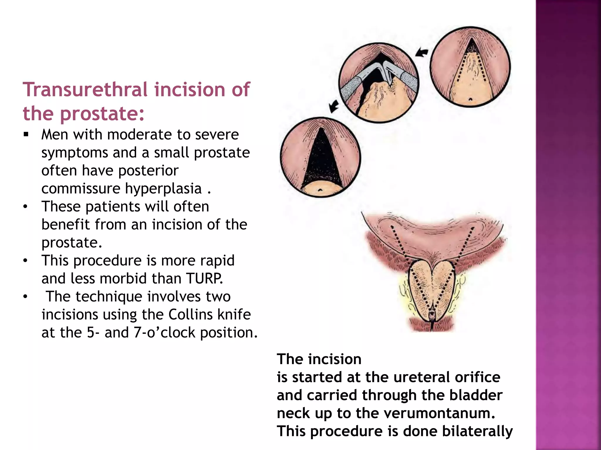 Transurethral incision of
the prostate:
 Men with moderate to severe
symptoms and a small prostate
often have posterior
commissure hyperplasia .
• These patients will often
benefit from an incision of the
prostate.
• This procedure is more rapid
and less morbid than TURP.
• The technique involves two
incisions using the Collins knife
at the 5- and 7-o’clock position.
The incision
is started at the ureteral orifice
and carried through the bladder
neck up to the verumontanum.
This procedure is done bilaterally
 