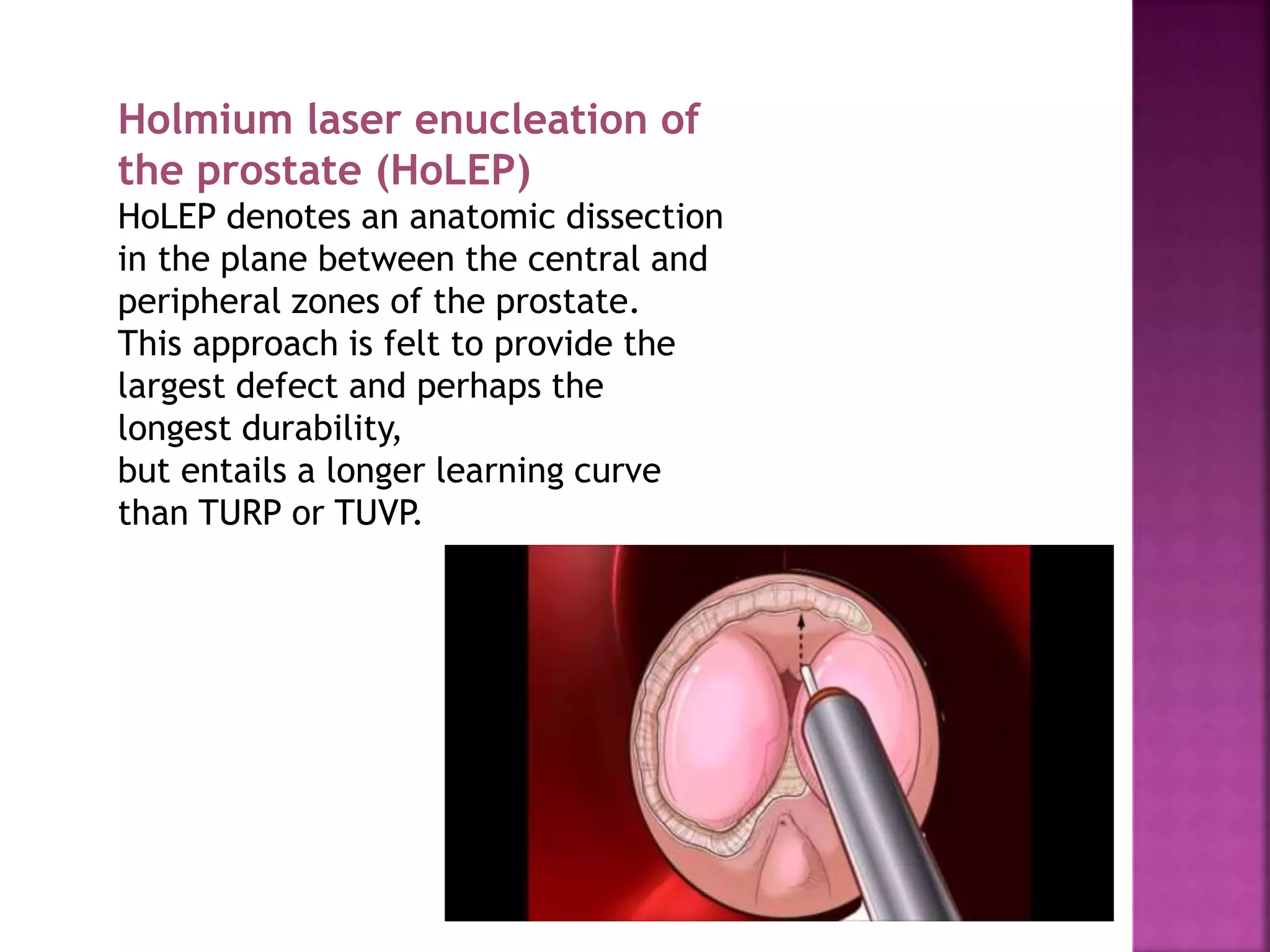 Holmium laser enucleation of
the prostate (HoLEP)
HoLEP denotes an anatomic dissection
in the plane between the central and
peripheral zones of the prostate.
This approach is felt to provide the
largest defect and perhaps the
longest durability,
but entails a longer learning curve
than TURP or TUVP.
 