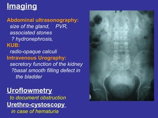 Imaging
Abdominal ultrasonography:
size of the gland, PVR,
associated stones
? hydronephrosis,
KUB:
radio-opaque calculi
Intravenous Urography:
secretory function of the kidney
?basal smooth filling defect in
the bladder
Uroflowmetry
to document obstruction
Urethro-cystoscopy
in case of hematuria
 
