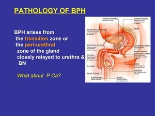 PATHOLOGY OF BPH
BPH arises from
the transition zone or
the peri-urethral
zone of the gland
closely relayed to urethra &
BN
What about P Ca?
 