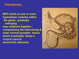 BPH starts as one or more
hyperplasic nodules within
the gland.. gradually
enlarging ….
may coalesce together…
compressing the intervening &
outer normal prostatic tissue
which eventually forms a
surgical capsule
around the adenoma
Pathogenesis
 