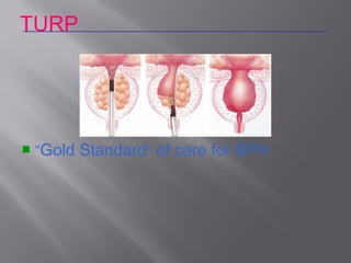 TURP
“Gold Standard” of care for BPH
 