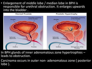 BENIGN PROSTATIC HYPERPLASIA.pptx