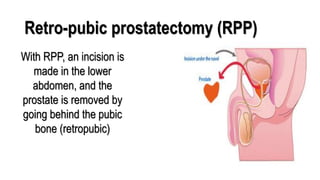 Retropubic Incision BENIGN PROSTATIC HYPERPLASIA.BPH. BPHpdf | PDF