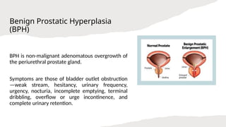 Benign prostatic hyperplasia presentation.ppsx