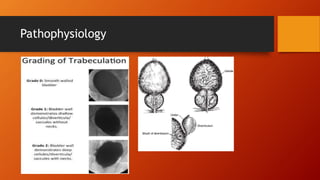 Benign prostatic hyperplasia (bph) | PPTX