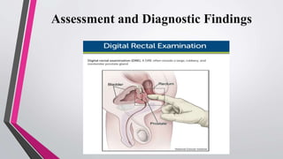 Benign prostatic hyperplasia (bph) | PPTX