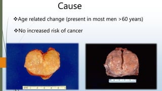 Cause
Age related change (present in most men >60 years)
No increased risk of cancer
 