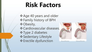 Age 40 years and older
Family history of BPH
Obesity,
Cardiovascular diseases,
Type 2 diabetes
Sedentary Lifestyle
Erectile dysfunction
Risk Factors
 