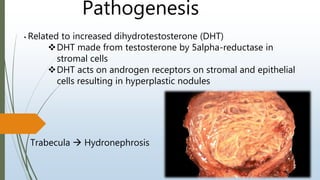 Pathogenesis
• Related to increased dihydrotestosterone (DHT)
DHT made from testosterone by 5alpha-reductase in
stromal cells
DHT acts on androgen receptors on stromal and epithelial
cells resulting in hyperplastic nodules
Trabecula  Hydronephrosis
 