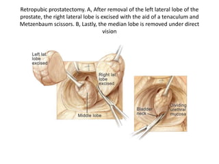 Suprapubic Prostatectomy
• Proper Positioning of the Patient
• After anesthesia has been induced, the patient is
positione...