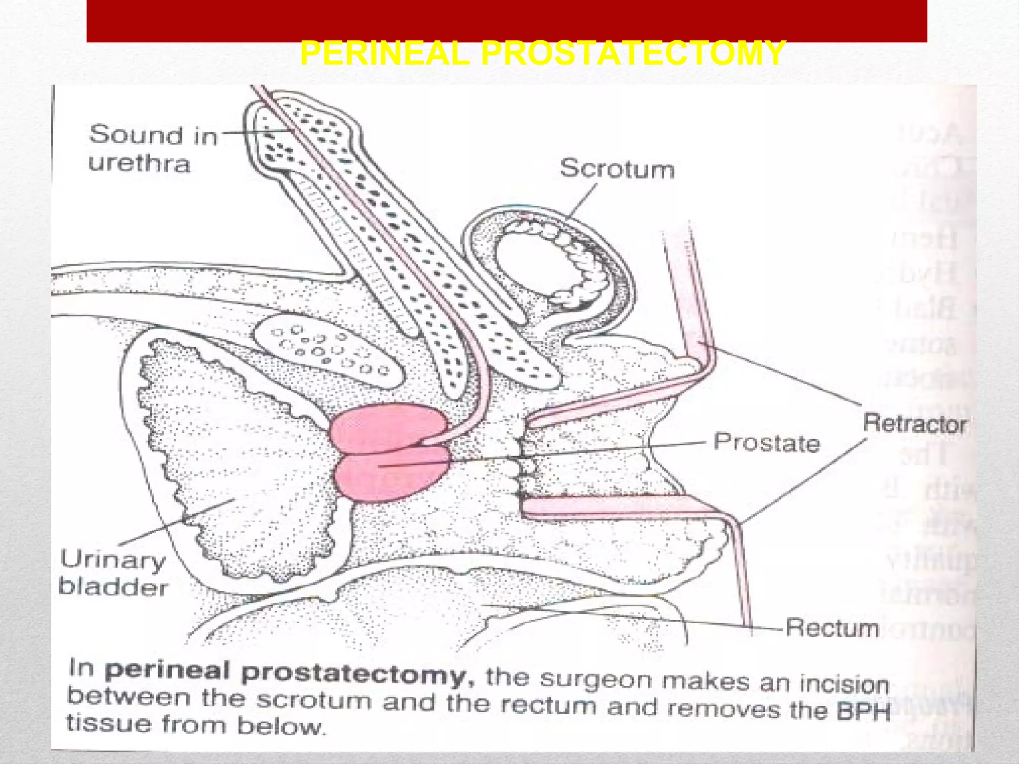 PERINEAL PROSTATECTOMY
 