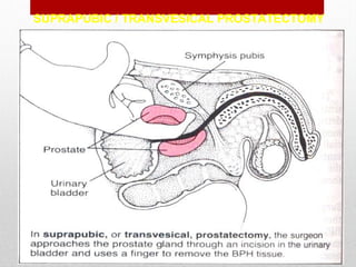 SUPRAPUBIC / TRANSVESICAL PROSTATECTOMY
 