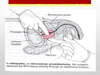 RETROPUBIC / RETROVESICAL PROSTATECTOMY
 