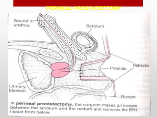 PERINEAL PROSTATECTOMY
 