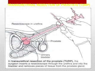 TRANSURETHRAL RESECTION OF PROSTATE (TURP)
 