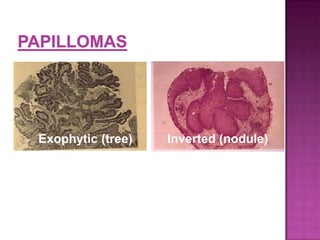 Exophytic (tree) Inverted (nodule)
 