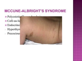  Polyostotic fibrous dysplasia
 Café-au-lait spots
 Endocrinopathology:
- Hyperthyroidism
- Precocious puberty in females
 