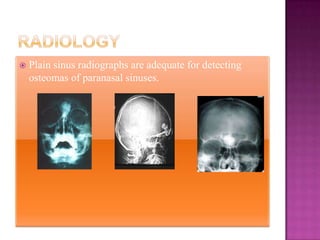  Plain sinus radiographs are adequate for detecting
osteomas of paranasal sinuses.
 