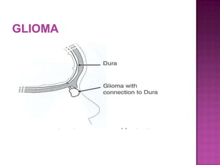  arise from the lateral wall of the nose or less
 often from the nasal septum.
 „ 60%extranasal
 „ 30% intranasal
 „ 10% are both
 „ 15% are connected to the dura
 „ intranasal type associated with dural
 attachment (35%) > extranasal type (9%).
 