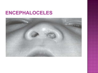  Bluish, soft, compressible, transilluminate,
pulsatile
 Enlarge with crying
 Positive Furstenberg test (bilateral compression
of internal jugular veins)
 Originate medially in the nose
 May have associated CSF leak
 