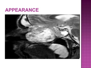  Macroscopically:
 well-delineated but nonencapsulated globular
 firm to rubbery yellow-tan mass
 Histologically:
 cellular Antoni A areas with Verocay bodies
 hypocellular myxoid Antoni B areas
 Immunocytohistochemistry:
 strongly and diffusely immunoreactive for S-100
protein
 