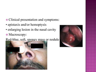  Clinical presentation and symptoms:
• epistaxis and/or hemoptysis
• enlarging lesion in the nasal cavity
 Macroscopy:
Red-blue, soft, spongy mass or nodule
 
