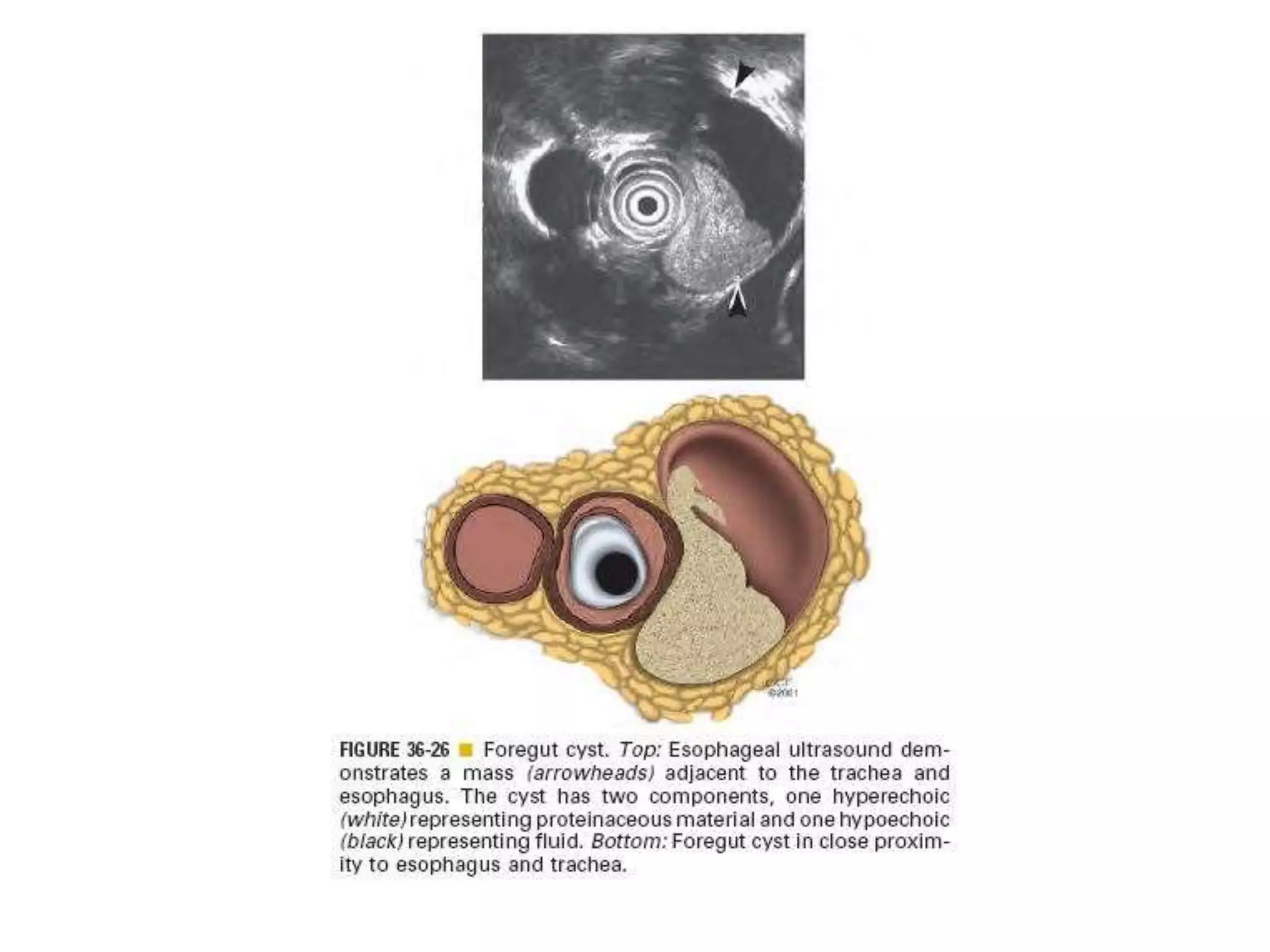 Benign tumor of esophagus | PPTX