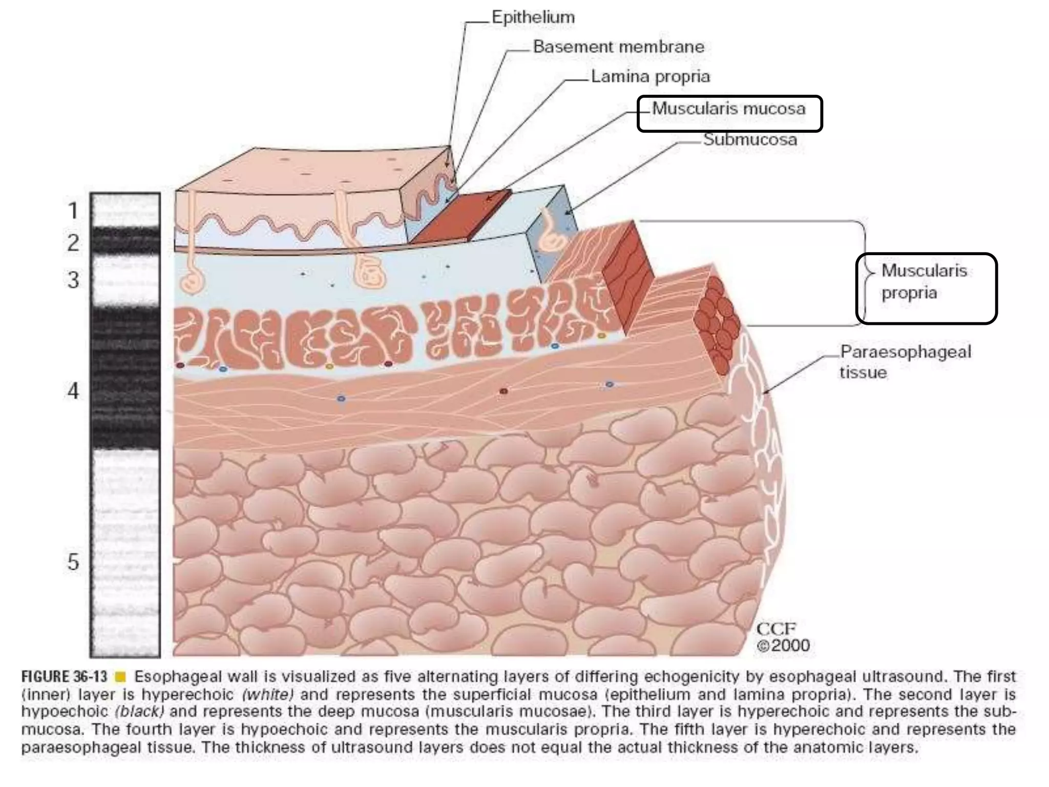 Benign tumor of esophagus | PPTX