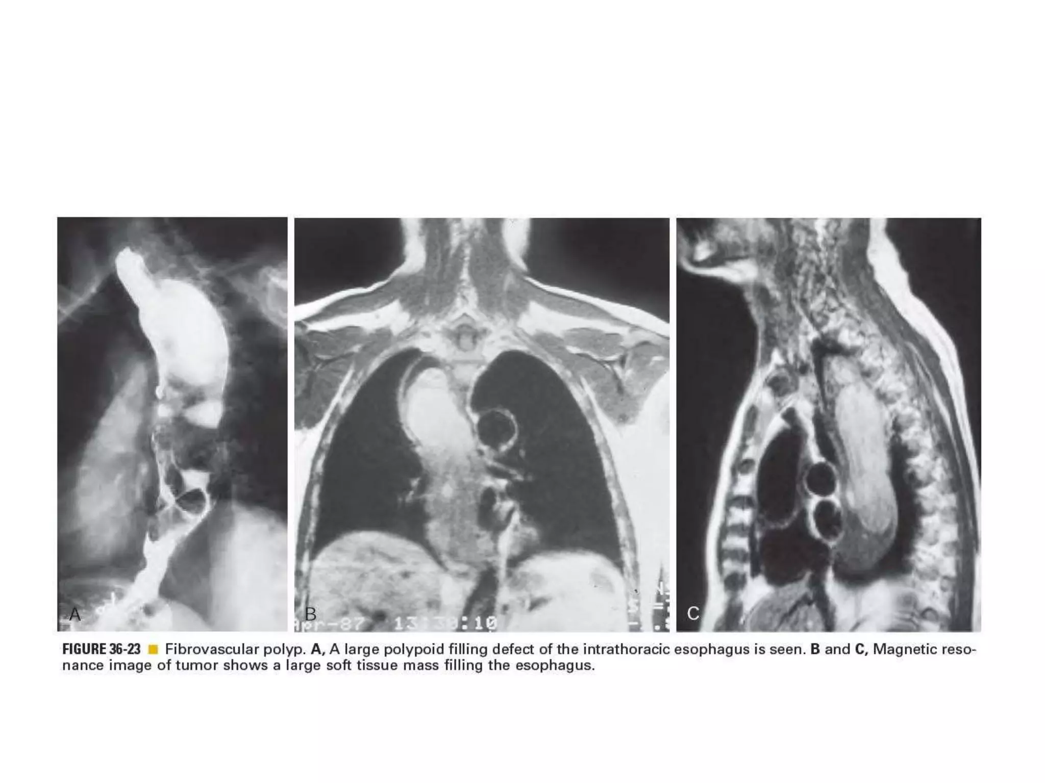 Benign tumor of esophagus | PPTX