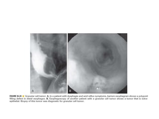 Benign tumor of esophagus | PPTX