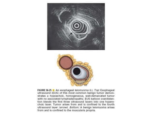 Benign tumor of esophagus | PPTX