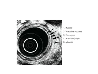 Benign tumor of esophagus | PPTX