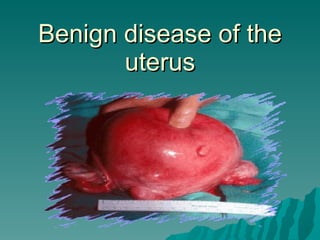 Benign disease of the uterus 