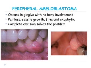 PERIPHERAL AMELOBLASTOMA
 Occurs in gingiva with no bony involvement
 Painless, sessile growth, firm and exophytic
 Complete excision solves the problem
 