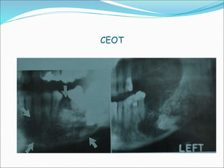 BENIGN TUMORS OF JAW.ppt