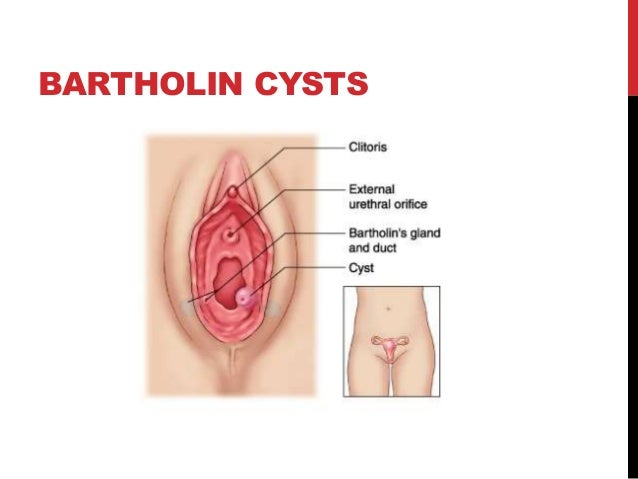 Benign tumours,cysts Benign tumours,cysts