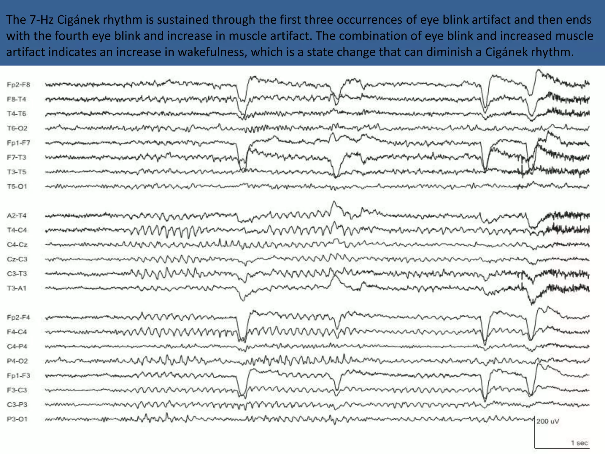The 7-Hz Cigánek rhythm is sustained through the first three occurrences of eye blink artifact and then ends
with the fourth eye blink and increase in muscle artifact. The combination of eye blink and increased muscle
artifact indicates an increase in wakefulness, which is a state change that can diminish a Cigánek rhythm.
 