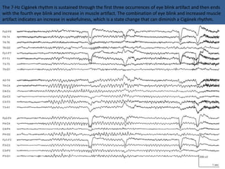 The 7-Hz Cigánek rhythm is sustained through the first three occurrences of eye blink artifact and then ends
with the fourth eye blink and increase in muscle artifact. The combination of eye blink and increased muscle
artifact indicates an increase in wakefulness, which is a state change that can diminish a Cigánek rhythm.
 