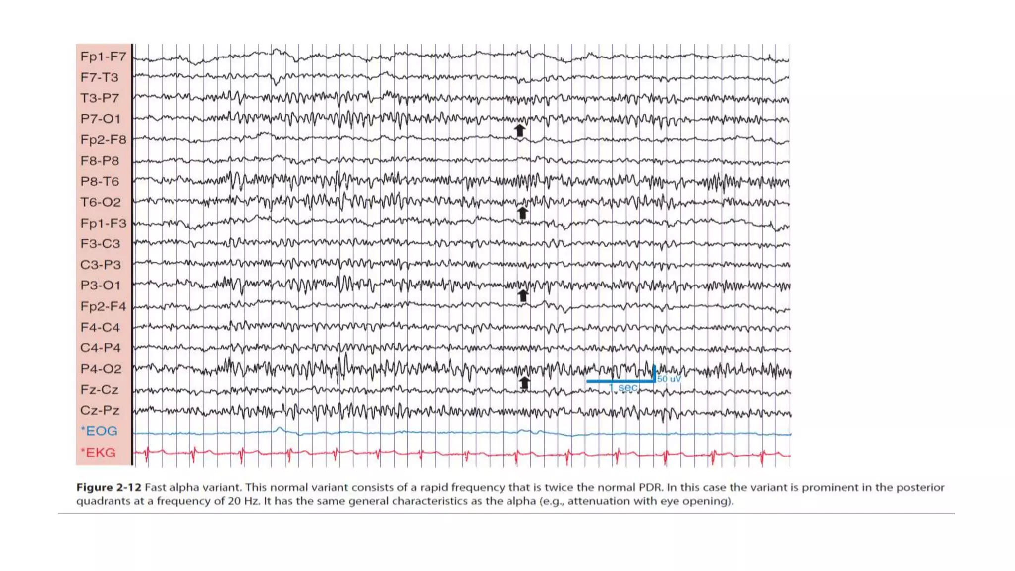 Normal And Benign Variants Atlas Of Pediatric Eeg
