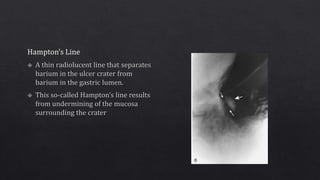 Hampton Line BENING AND MALIGANT GASTRIC ULCERS- Barium meal findings.pptx