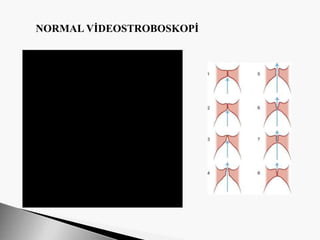 NORMAL VİDEOSTROBOSKOPİ
 