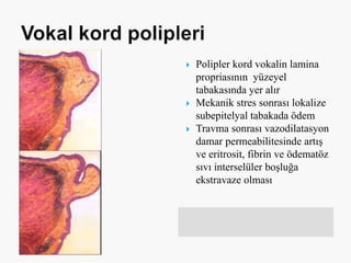  Polipler kord vokalin lamina
propriasının yüzeyel
tabakasında yer alır
 Mekanik stres sonrası lokalize
subepitelyal tabakada ödem
 Travma sonrası vazodilatasyon
damar permeabilitesinde artış
ve eritrosit, fibrin ve ödematöz
sıvı interselüler boşluğa
ekstravaze olması
 