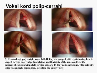 A, Hemorrhagic polyp, right vocal fold. B, Polyp is grasped with right-turning heart-
shaped forceps to reveal pedunculation and flexibility of the mucosa. C, At the
moment of excision with a left-turning scissors. D, Tiny residual wound. This patient’s
voice was entirely normalized, including the upper voice.
 